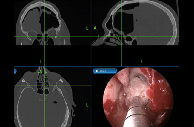 Coronal CT scan 2 months post surgery demonstrating resolution of pneumocephalus as well as intact skull base (reconstructed with an underlay bone graft and overlay nasoseptal flap).